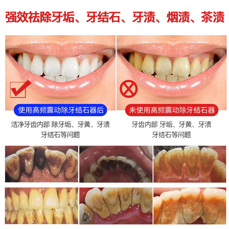 Electric Toothbrush Water Toothpick Dental Calculus Remover Teeth Care Tool Electric Teeth Cleaning Machine Ultrasonic